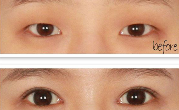 單眼皮可以只開(kāi)眼角嗎?效果怎么樣?