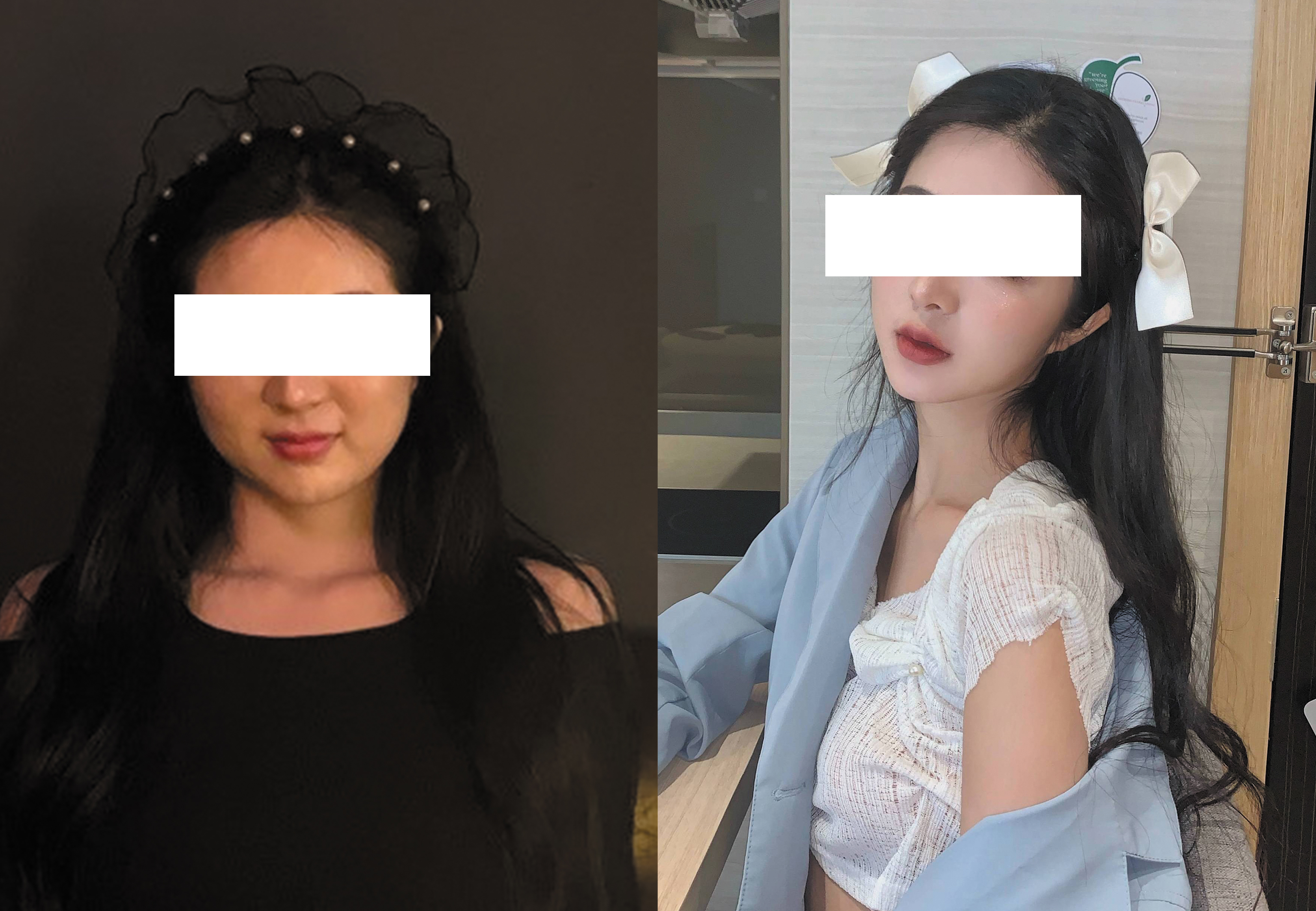 合肥藝星周海林醫(yī)生手術(shù)效果圖1