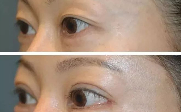 開外眼角需要多久恢復(fù)？