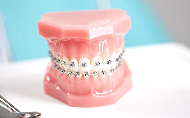 牙齒正畸費(fèi)用一般多少？