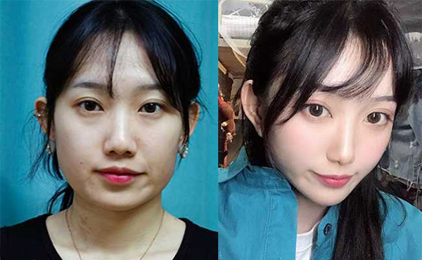 一般做下頜角整容風(fēng)險有哪些?可以避免嗎?