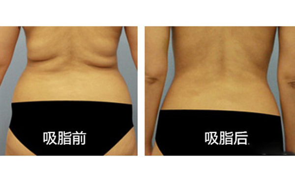 腹部吸脂需要多久恢復(fù)？