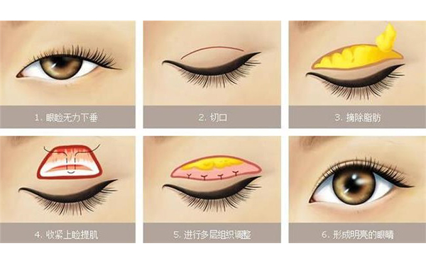 上瞼下垂價(jià)格多少?上瞼下垂術(shù)后有哪些問題?
