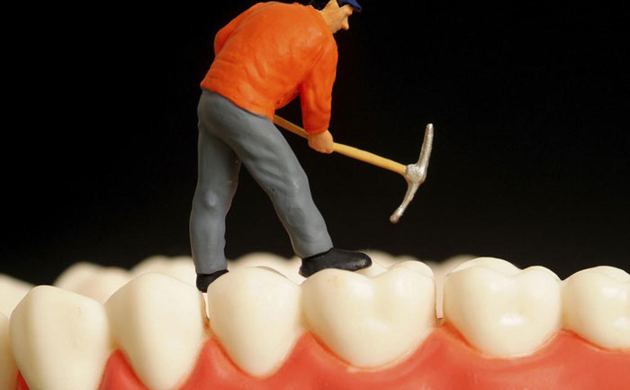 鑲牙要多少錢一顆費用？