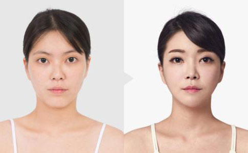 韓式埋線雙眼皮多久恢復(fù)自然？