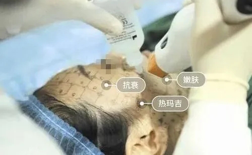 牙齒矯正期間是不能做熱瑪吉嗎？