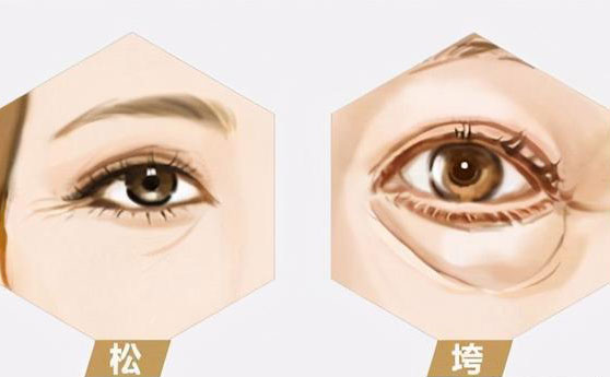 無痛去眼袋價(jià)格多少錢?