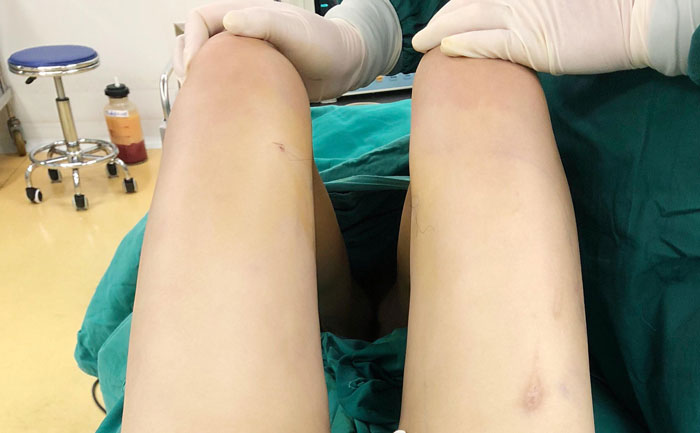 腿部吸脂手術(shù)多少錢？腿部吸脂會不會留下后遺癥？