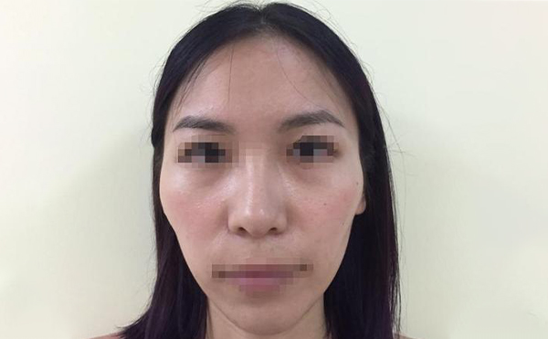 顴骨降低手術(shù)疼不疼？