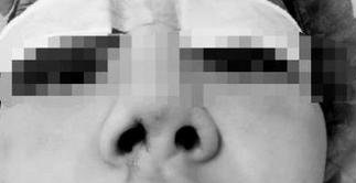 隆鼻手術術前效果