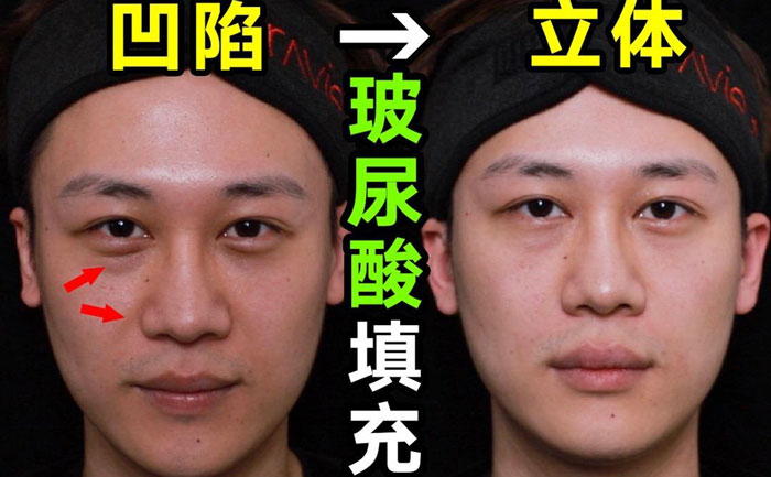 淚溝填充用什么方法最好？淚溝填充手術(shù)大約多少錢？