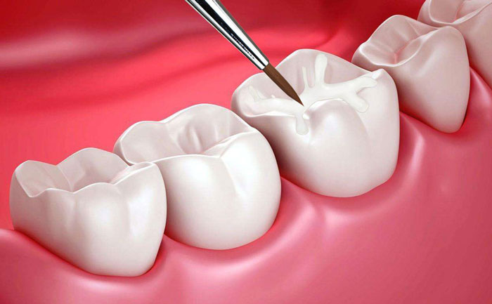 貴金屬烤瓷牙有哪些？貴金屬烤瓷牙的種類