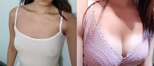假體隆胸手術(shù)效果對(duì)比圖3