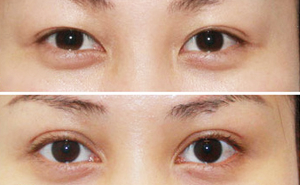 內(nèi)雙做雙眼皮是什么價(jià)格？效果怎么樣？