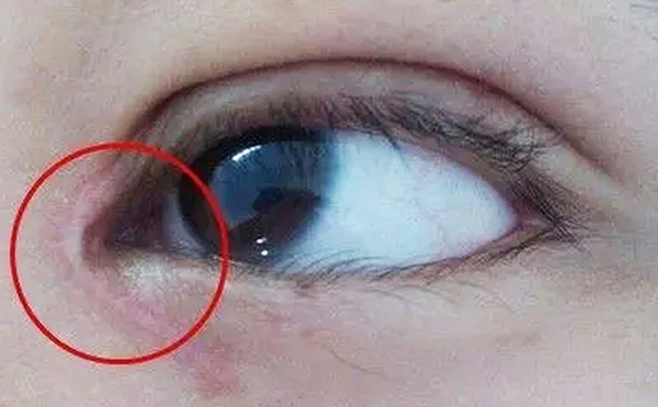 內(nèi)眼角修復(fù)難不難？哪些情況需要修復(fù)?