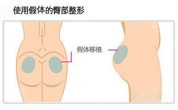 假體豐臀多少錢？假體豐臀效果是永久的嗎？