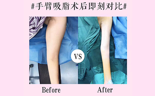 手臂吸脂會反彈嗎？