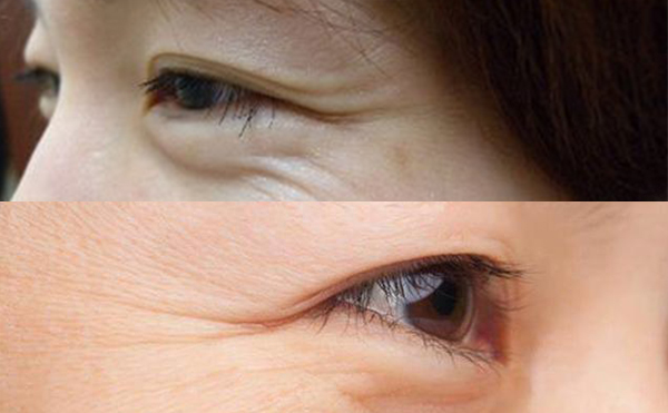 魚尾紋有哪幾種類型？