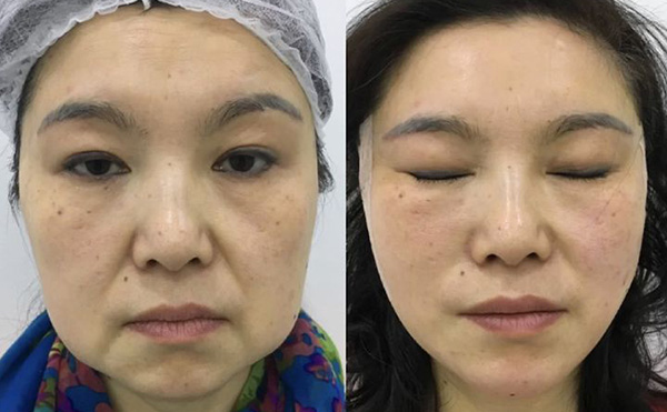 超聲刀適合哪些人群？