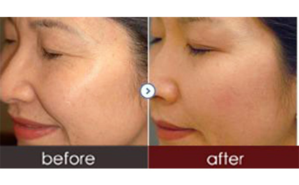 水光針有副作用嗎？