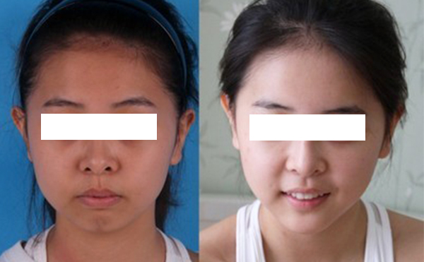 激光美白有什么優(yōu)缺點(diǎn)？