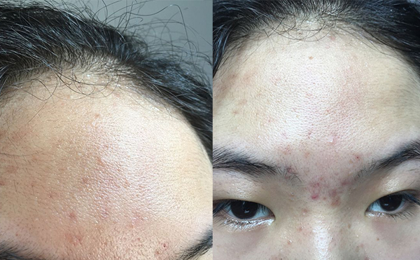 哪些人不適合做冰點(diǎn)面部脫毛？