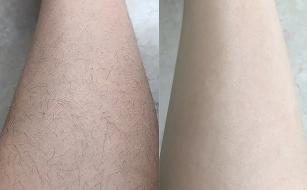 冰點(diǎn)脫腿毛效果怎么樣？