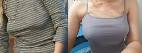 產(chǎn)后胸部下垂手術(shù)前后對比