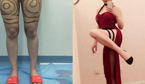 大腿吸脂前后效果對(duì)比圖