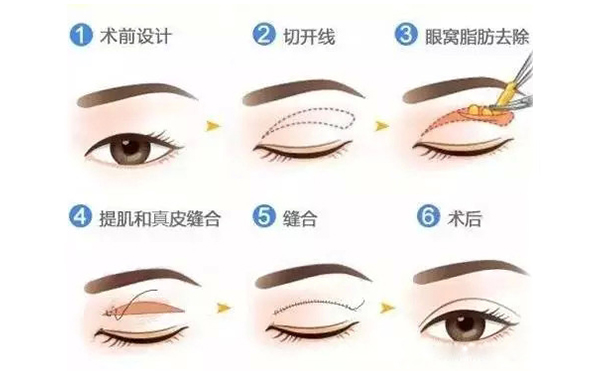 全切雙眼皮跟埋線的區(qū)別是什么？哪個(gè)好？