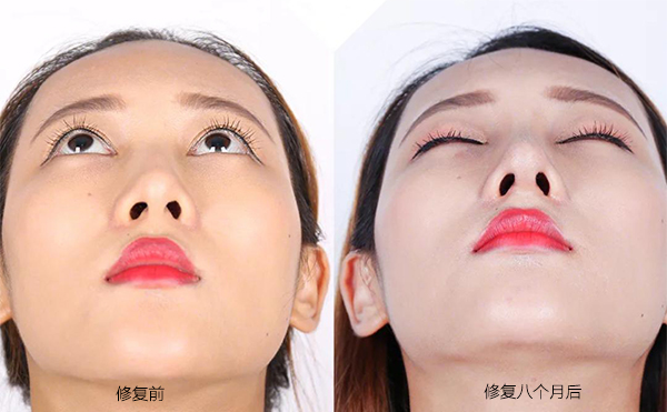 隆鼻手術(shù)失敗怎么辦？修復(fù)費(fèi)用要多少？