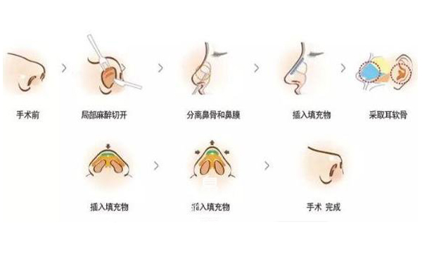 耳軟骨隆鼻效果怎么樣？要多少錢？