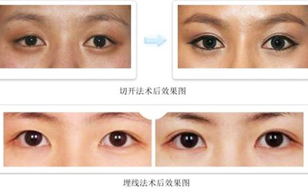 雙眼皮埋線和切開哪個比較好?疼痛程度有什么不同？