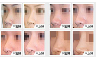 玻尿酸隆鼻好還是假體隆鼻好？更推薦哪一種？