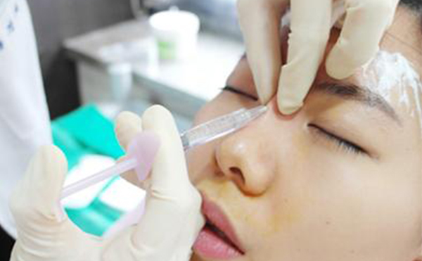 玻尿酸隆鼻大概要花多少錢？能維持多久？