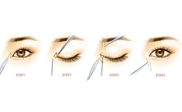 開內(nèi)眼角是什么價(jià)格?術(shù)后有什么注意事項(xiàng)?