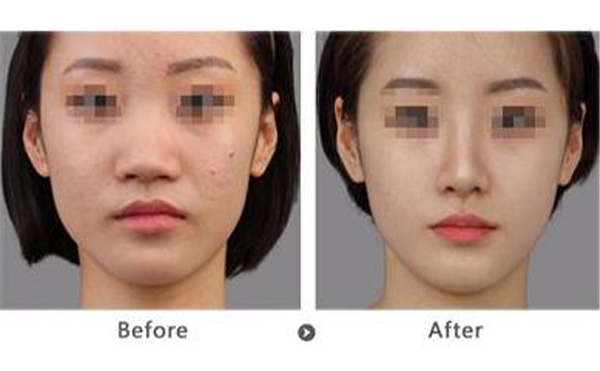 膨體隆鼻術(shù)后效果怎么樣？手術(shù)疼嗎？