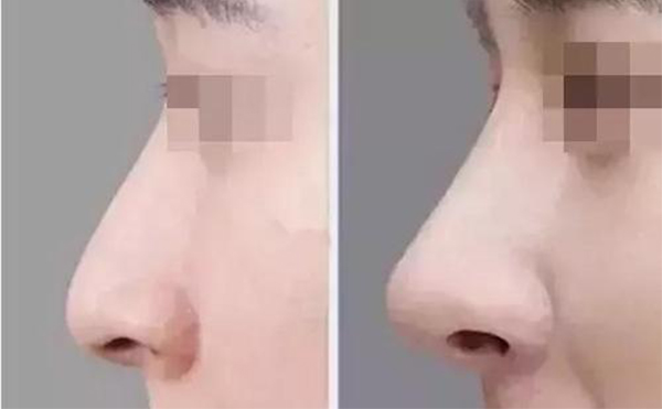 隆鼻前應該做什么準備確保有好的手術(shù)效果？