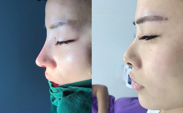 做隆鼻手術(shù)需要滿(mǎn)足什么條件？月經(jīng)期間可以做隆鼻手術(shù)嗎？