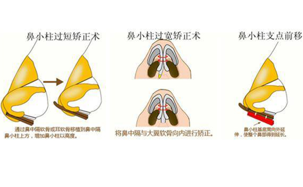 鼻小柱缺損修復有幾種方法？為什么會出現鼻小柱缺損的情況