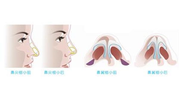鼻翼縮小整形安全嗎？術(shù)后會不會影響呼吸