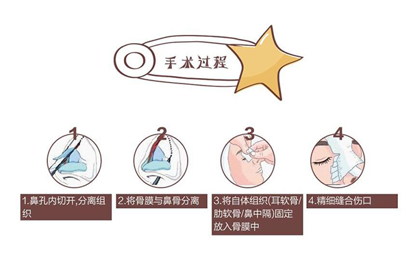 自體軟骨隆鼻為什么這么受歡迎?