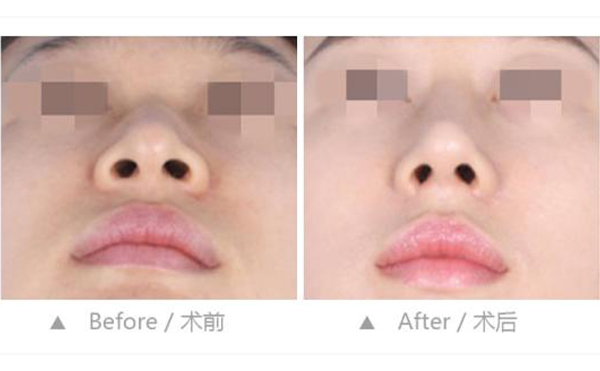 鼻孔縮小整形是怎么做的？效果好不好？