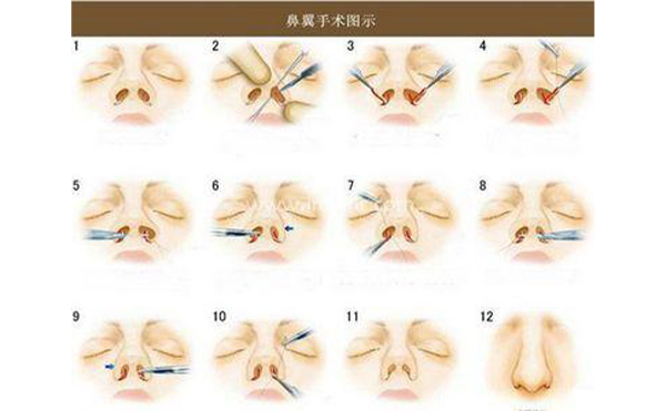 南昌愛思特做鼻翼縮小怎么樣?時間久了會不會反彈