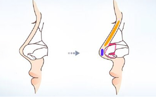 鼻小柱在什么情況下會(huì)影響美觀?鼻小柱的各種畸形是如何矯正的