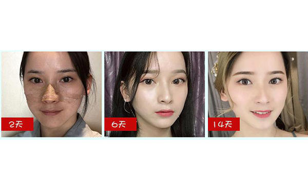 全肋鼻和半肋鼻有什么區(qū)別？做全肋好還是半肋好