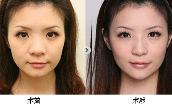 為保證鼻頭肥大矯正手術效果，術前術后應該注意些什么？