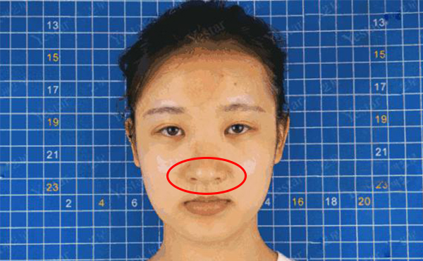 鼻頭肥大是什么原因造成的？怎么解決鼻頭肥大