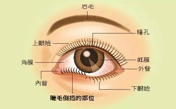 倒睫有什么危害?倒睫手術(shù)要多少錢?