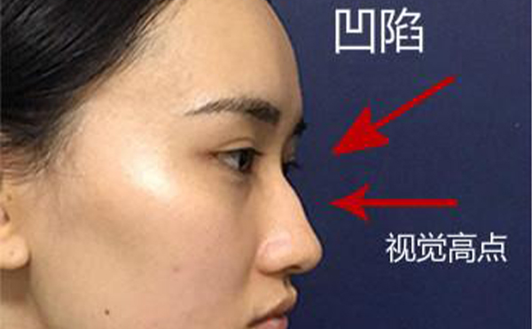 駝峰鼻整形是怎么做的？不同嚴(yán)重程度的駝峰鼻矯正方法一樣嗎？